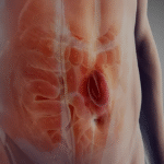 رفع المستقيم بالمنظار مع أ.د. أحمد سفينة | حل فعّال للإمساك المزمن واضطرابات إخراج البراز