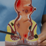 ما هو الفتق السُرّي؟