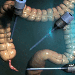 عملية الزائدة بالمنظار في مصر