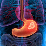 أعراض سرطان المعدة المبكرة