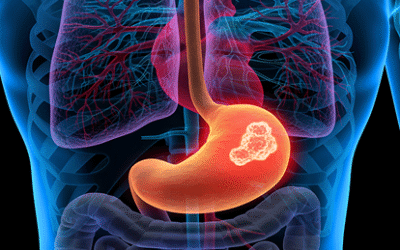 أعراض سرطان المعدة المبكرة