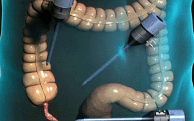 عملية الزائدة بالمنظار في مصر