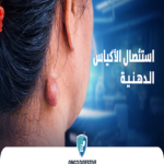 استئصال الأكياس الدهنية مع أ.د. أحمد سفينة | علاج آمن وسريع بدون ألم