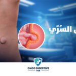 علاج الفتق السرّي بالمنظار مع أ.د. أحمد سفينة | أحدث تقنيات إصلاح فتق السرة بأمان كامل